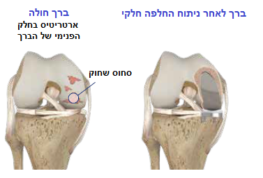 אילוסטרציה של מפרק ברך עם פגיעה חד לשכתית והחלפה חד לשכתית של הברך