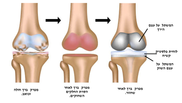 תמונה המדגימה את שלבי המעבר ממפרק שחוק למפרק מלאכותי